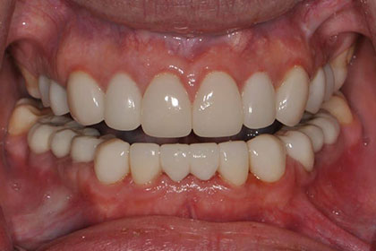 After-Dental-Implants