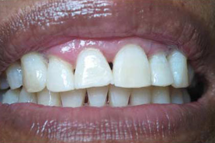 After-teeth-whitening