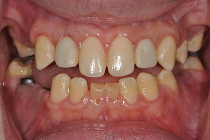 Before-Dental-Implants