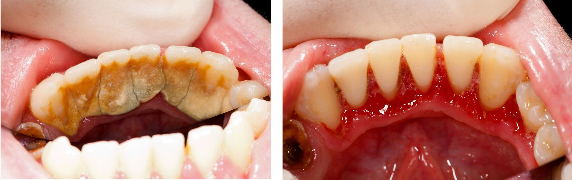 before-and-after-scaling-and-root-planing-treatment