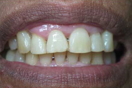 before-teeth-whitening