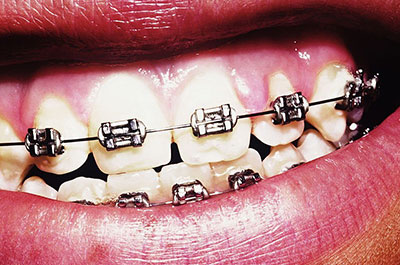 teeth braces treatment addis ababa