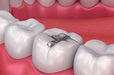 dental filling treatment