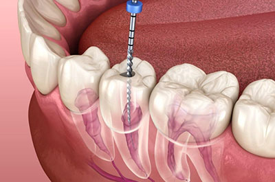 root-canal-treatment-addis-ababa