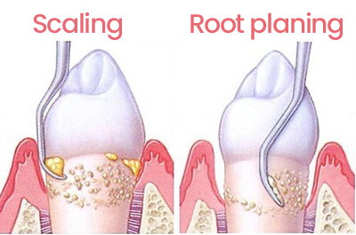 scaling-and-root-planing treatment