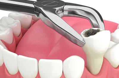 dental extraction treatment